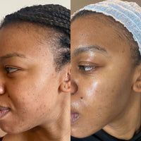 Pigmentation, Dark Marks and Uneven Skin Rivaval