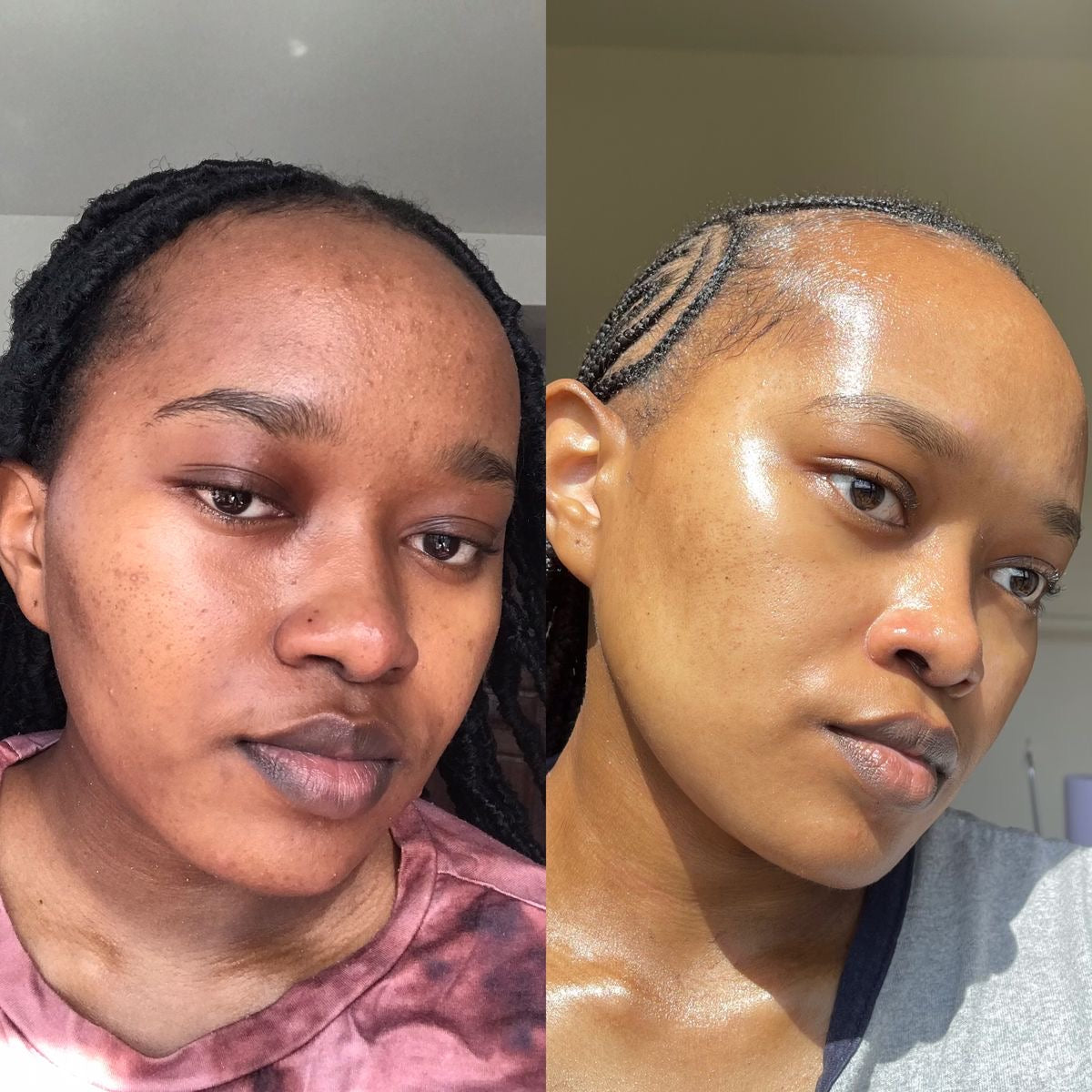 Pigmentation, Dark Marks and Uneven Skin Rivaval