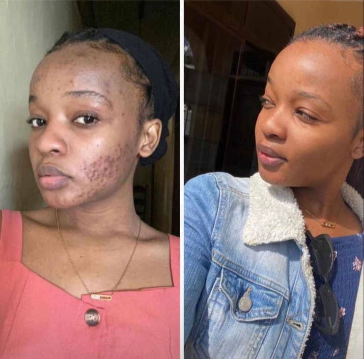 Pigmentation, Dark Marks and Uneven Skin Rivaval