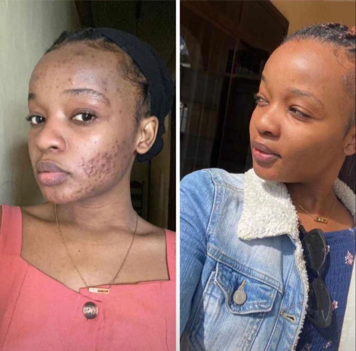 Pigmentation, Dark Marks and Uneven Skin Rivaval